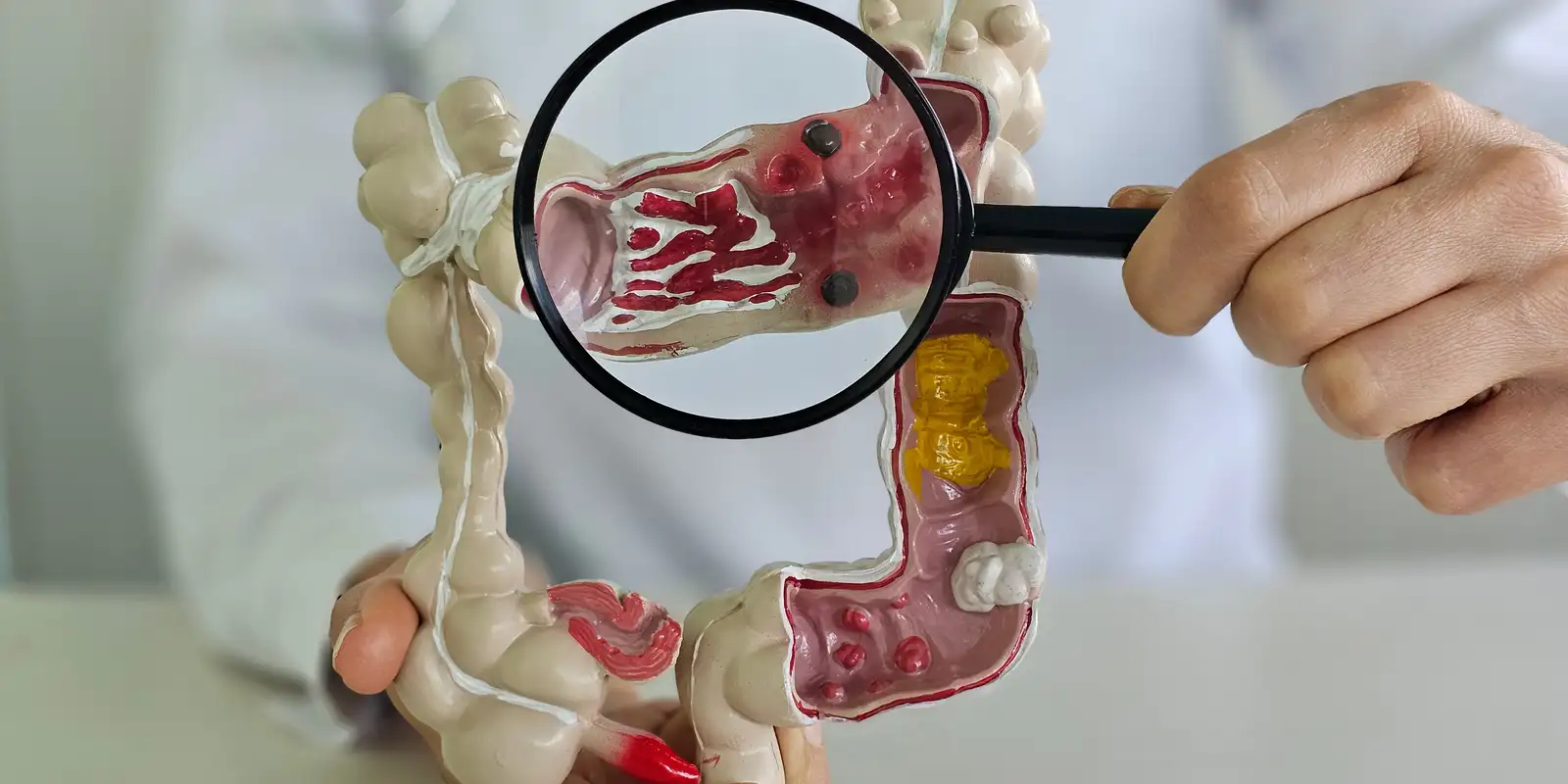 Doenças inflamatórias intestinais aumentam cinco vezes no Brasil em 13 anos